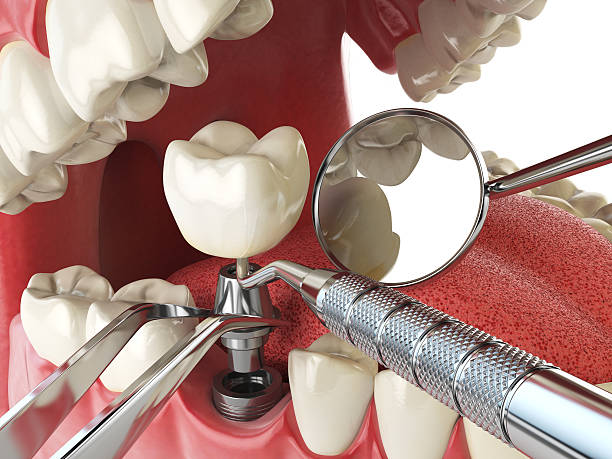 Best Emergency Wisdom Tooth Extraction in Postville, IA